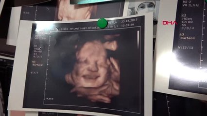 Antalya anne karnındaki bebeklerin gülümseten pozları