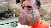 Indian priest worshipped as a god due to massive facial tumour says he's nearly ‘exhausted savings' in search for cure
