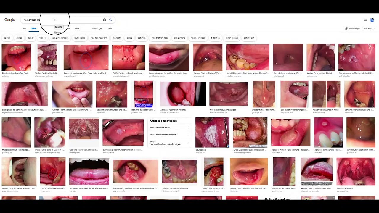 weißer Fleck im Mund