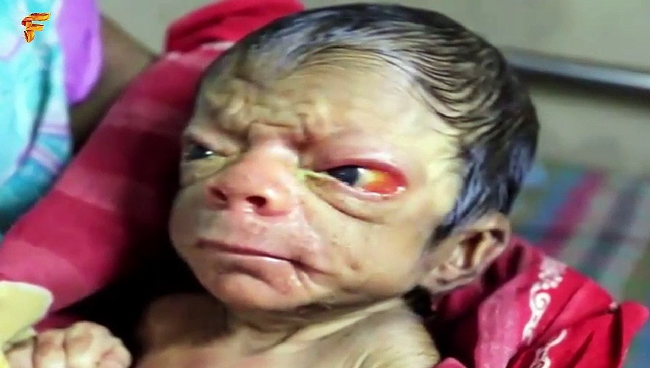 Baby Boy from Bangladesh with Progeria Looks Like an 80 Year Old Video by Facts And Mysteries