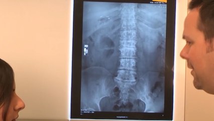 bd-fracturas-vertebrales-por-osteoporosis-240220