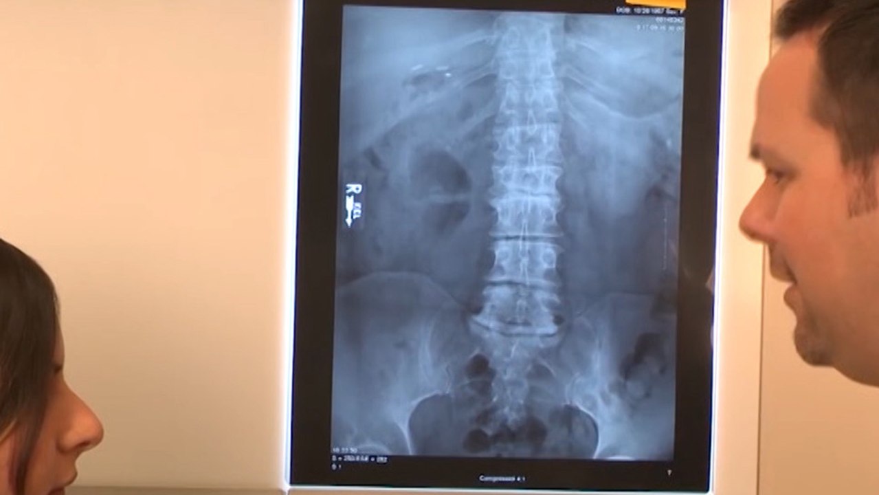 bd-fracturas-vertebrales-por-osteoporosis-240220