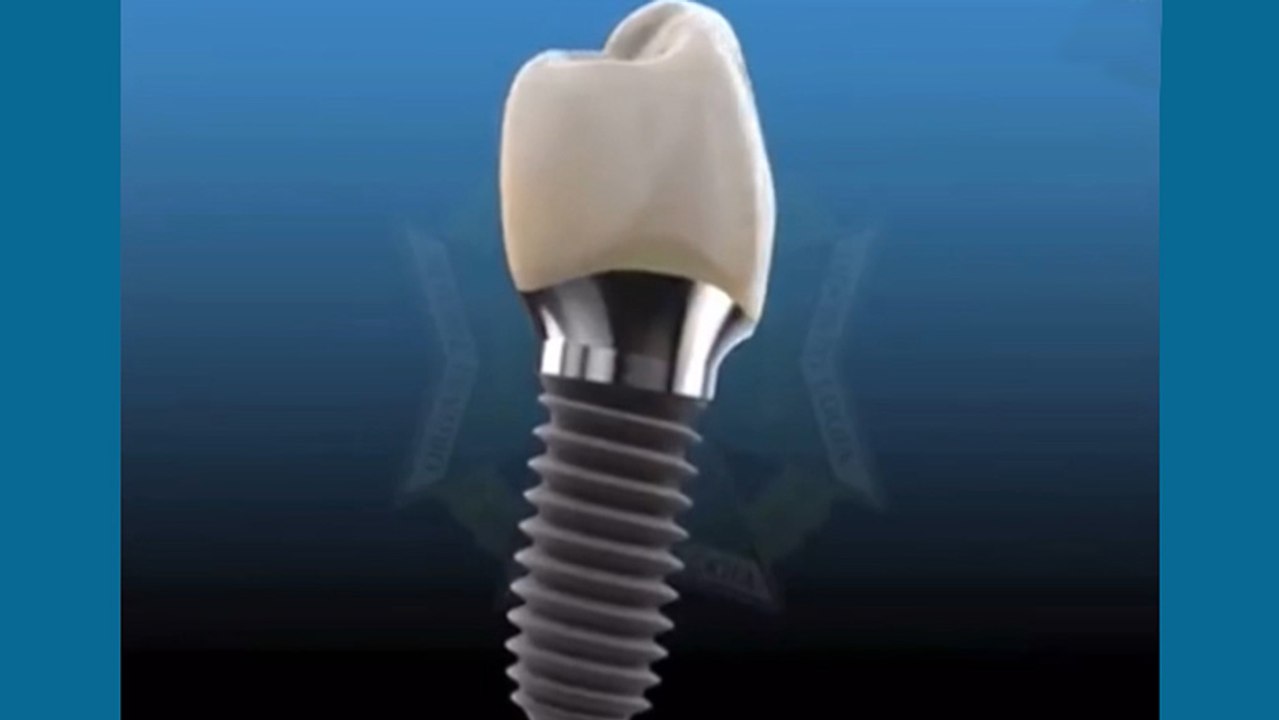 bd-implantes-dentales-240220