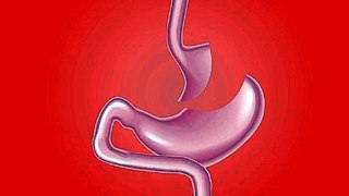 Gastric bypass surgery stomach' gastric bypass surgery stomach pain, gastric bypass surgery stomach cancer, gastric bypass surgery stomach pain symptoms, gastric bypass surgery stomach staples, gastric bypass surgery stomach after,