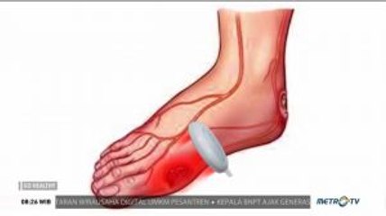 Stroke Bukan Akhir Segalanya (3)