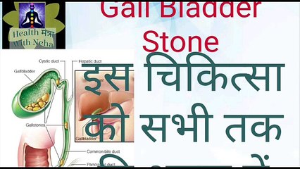 Gall Bladder Stone treatment,अब आपरेशन नहीं, केवल इतना करना होगा पहली बार ही पथरी निकलना शुरू होगा