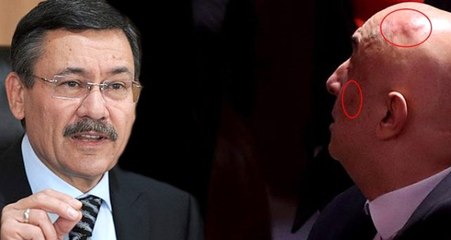 Melih Gökçek'ten CHP'li Özkoç'un kavga sonrası ortaya çıkan fotoğrafına ilk yorum: Kafa resmen çökmüş