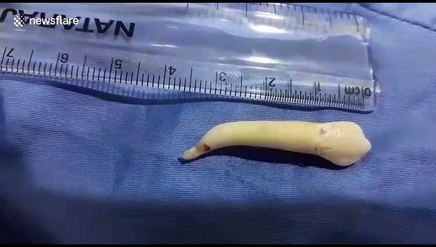 Indian dentist claims he removed the longest ever teeth from patient