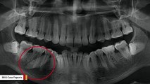 'Bad Tooth' In Man's Mouth Turns Out To Be Something Unexpected