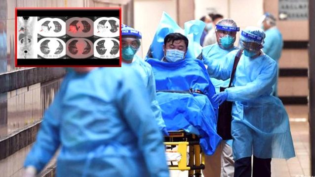 Koronavirüs salgını nedeniyle hayatını kaybeden Çin'li adamın röntgen fotoğrafları ortaya çıktı
