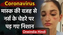 Coronavirus: पीड़ितों का इलाज कर रही Nurse के Face पर Mask की वजह से पड़ गए निशान | वनइंडिया हिंदी