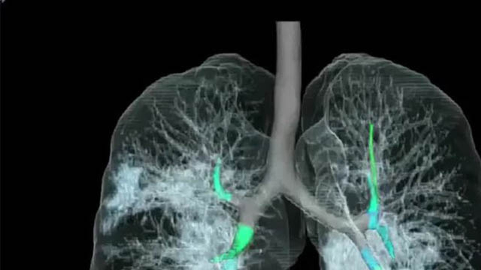 ⁣Coronavirus : Corona से प्रभावित Lungs की पहली 3D तस्वीर Viral | Coronavirus Lungs Image | Boldsky
