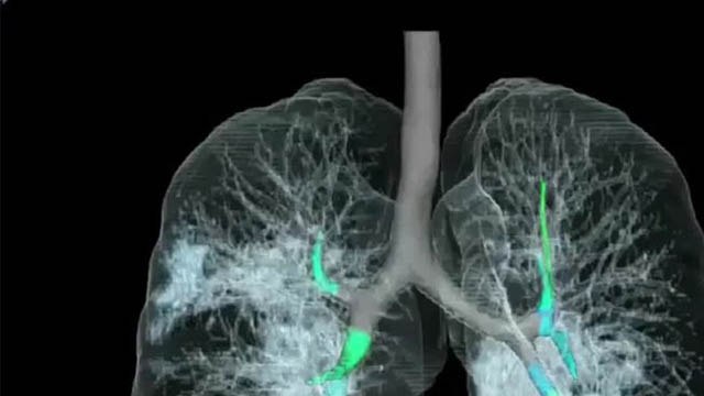 Coronavirus : Corona से प्रभावित Lungs की पहली 3D तस्वीर Viral | Coronavirus Lungs Image | Boldsky
