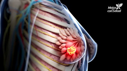Cáncer de mama - Síntomas y señales de alerta