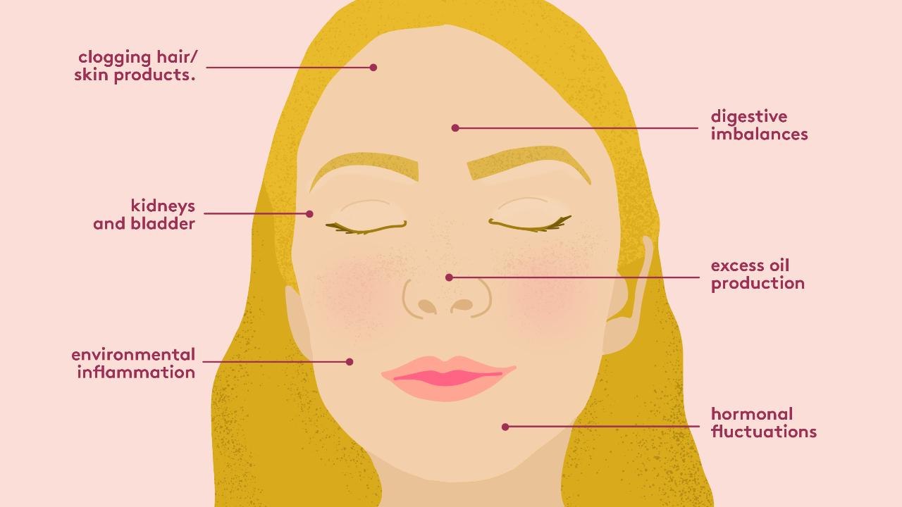 Acne Face Mapping: What Your Breakouts Are Trying to Tell You