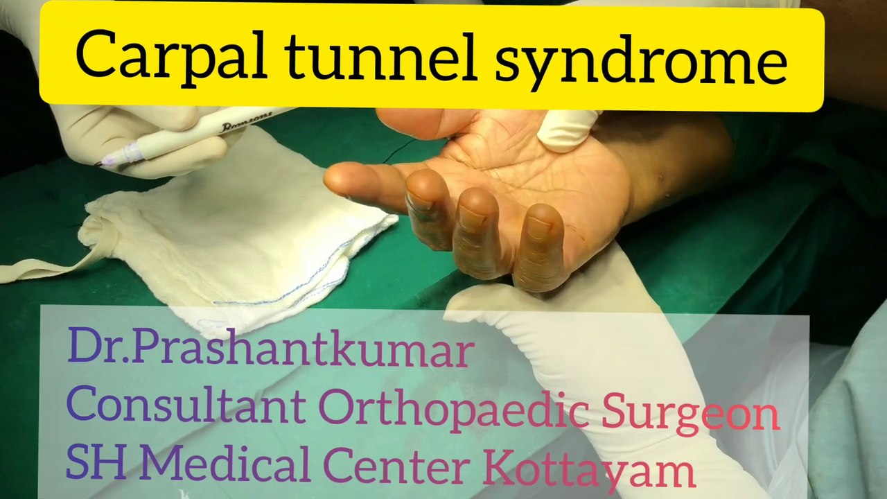 CARPAL TUNNEL RELEASE | LIVE SURGICAL PROCEDURE | CARPAL TUNNEL SYNDROME EVERYTHING YOU NEED TO KNOW | HAND SURGERY | TRICKS AND TECHNIQUES OF SURGICAL PROCEDURE