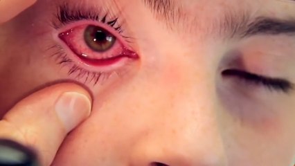 bd-conjuntivitis-posible-sintoma-de-covid-19180320