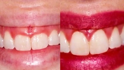 Gum contouring can transform your smile