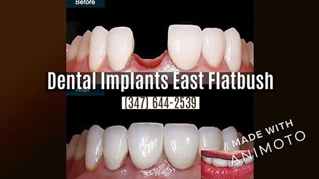 Dental Implants East Flatbush