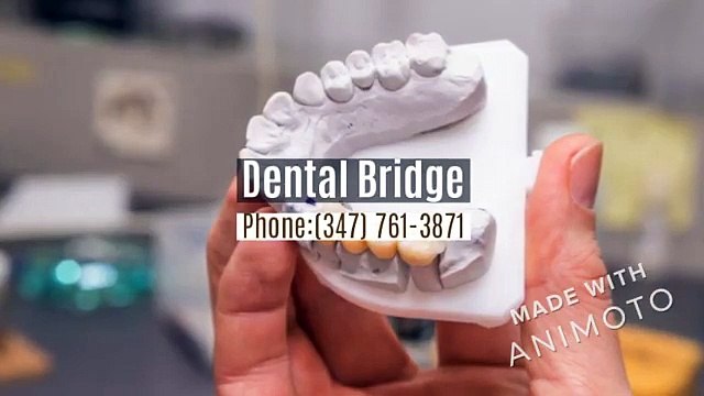 Dental Bridge