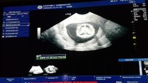 Primera ecografia