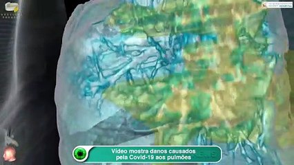 Vídeo mostra danos causados pela Covid-19 aos pulmões