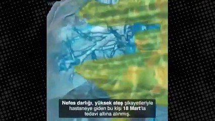 Koronavirüsün akciğere verdiği hasarı gösteren video!