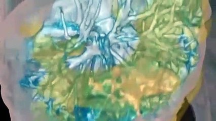 İşte Koronavirüs taşıyan bir hastanın akciğer görüntüleri