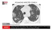 Le docteur Milhau dévoile des images inédites de poumons atteints par le Covid-19