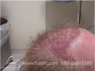 HAIR TRANSPLANT DALLAS:  LONG HAIR STRATEGY (BREAKTHROUGH)