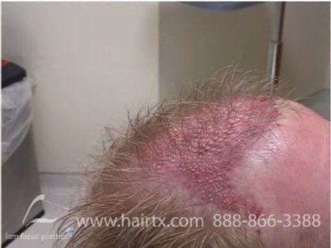 HAIR TRANSPLANT DALLAS: LONG HAIR STRATEGY (BREAKTHROUGH)