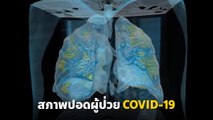 ชมคลิปภาพสแกน 360 องศา นี่แหละปอดของผู้ป่วย COVID-19
