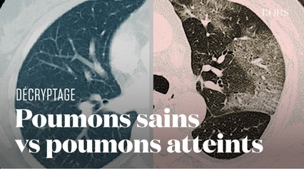 A quoi ressemblent les poumons des malades du Covid-19 ? Une interne en radiologie nous explique