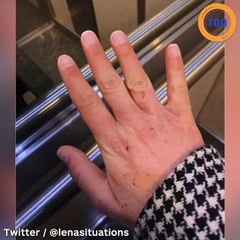 Coronavirus : quand les mains des soignants sont ravagées par le gel hydroalcoolique