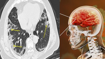 Brain को जकड़ने लगा है Virus, Patient खो रहे है बोलने की क्षमता । Boldsky