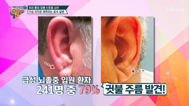 ≈주름≈ 위치로 예측하는 여러 가지 질병 신호!