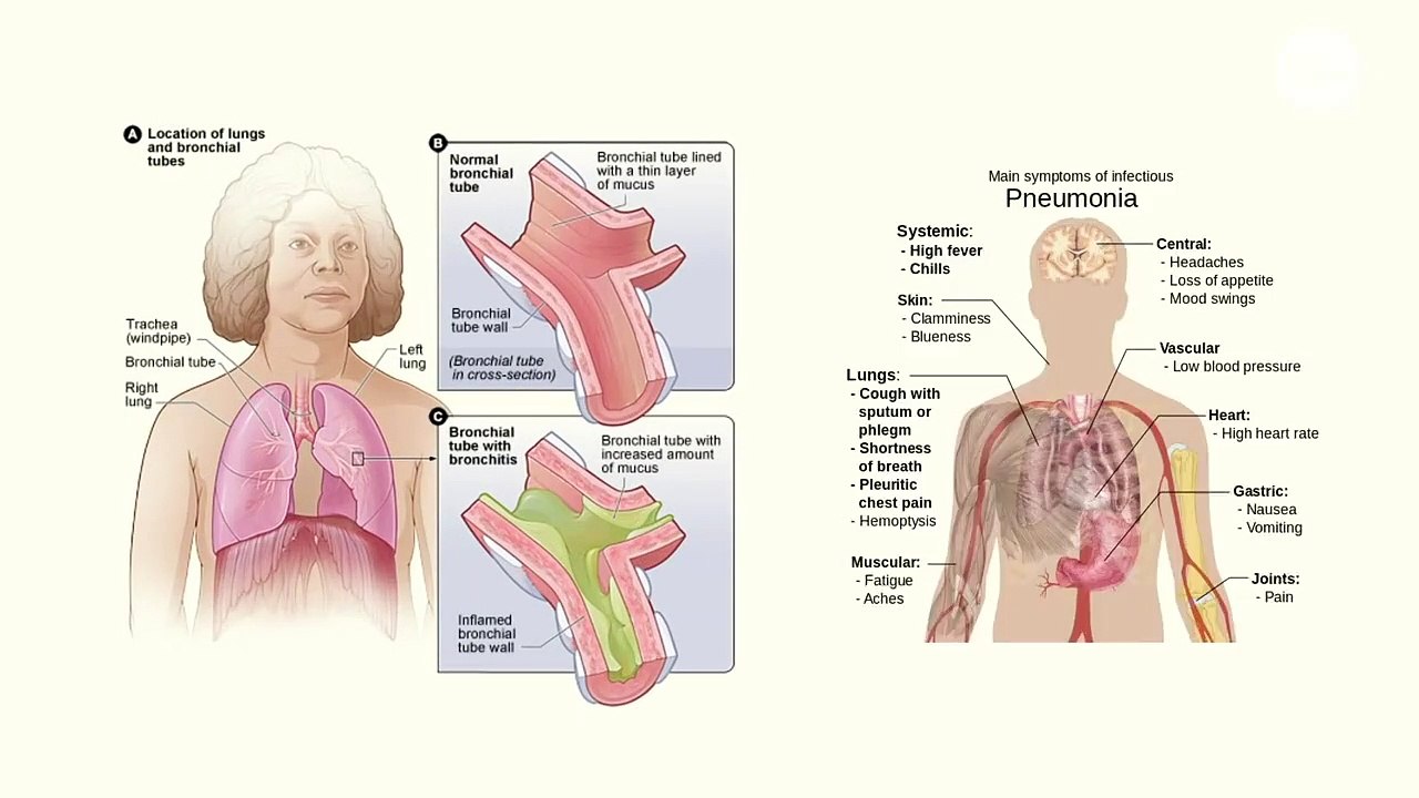 How Coronavirus Attacks the Body