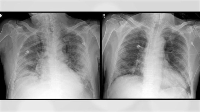 세브란스병원 연구팀 혈장치료 환자 2명 회복...1명 퇴원 / YTN