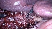 Dr Hehir Hot gallbladder