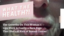 The Growths On This Woman's Lips Were Actually a Rare Sign That She's at Risk of Breast Cancer