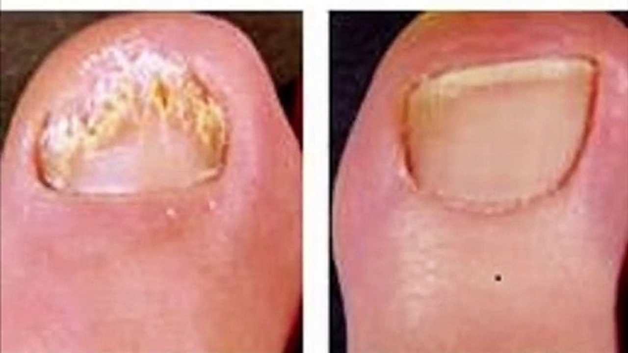 Toenail Fungus Treatment In Charlotte, NC