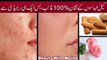 Acne spot removal treatment at home in urdu | Home remedy for acne spot | Beauty tips