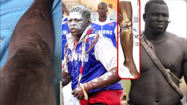 Opération du genou Ali Ndiaye interpelle les lutteurs, parle du cas de Yekini et conseille Lac Rose