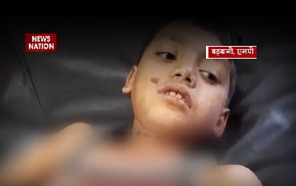 Madhya Pradesh: 8-year-old boy injured after falling from tree in Barwani