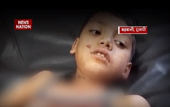 Madhya Pradesh: 8-year-old boy injured after falling from tree in Barwani