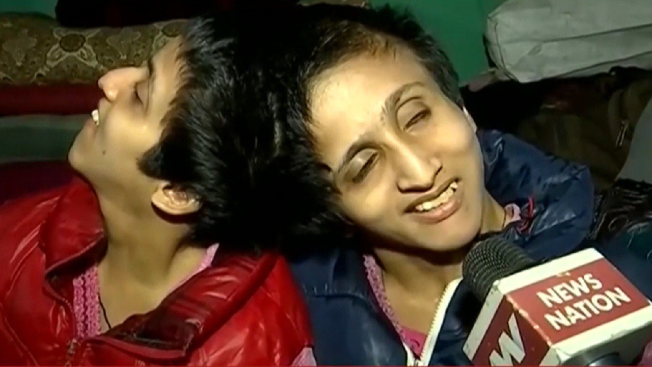 Conjoined Twin Sisters Saba-Farah Wish Salman K...