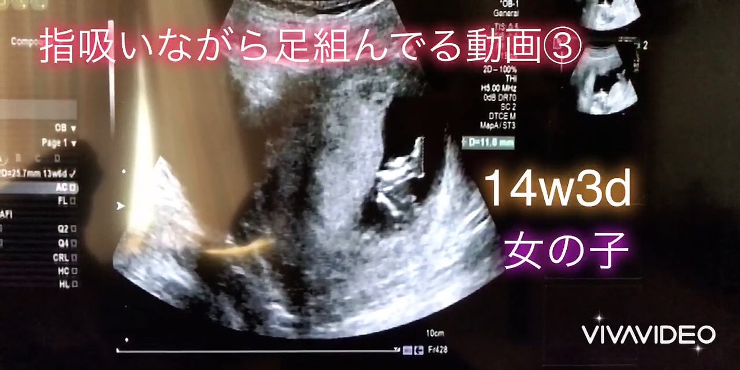 【ultrasonic diagnostics】A baby sucks her finger while crossing her legs ③☆pregnancy,fetus