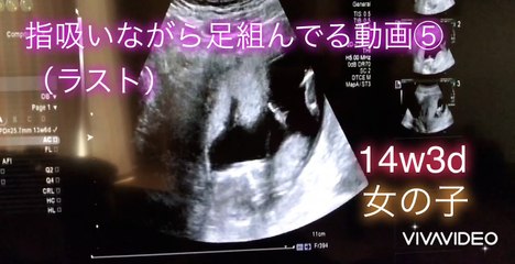 【ultrasonic diagnostics】A baby sucks her finger while crossing her legs ⑤☆pregnancy,fetus
