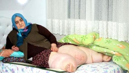 Fil hastalığı nedeniyle 4 yıldır evden çıkamayan kadın, ayağa kalkabilmek için yardım bekliyor