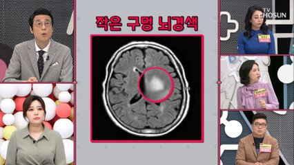 뇌에 구멍이? 치매 부르는 ※작은 구멍 뇌경색※